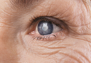 Cataracts Maine Close up of an eye with cataracts