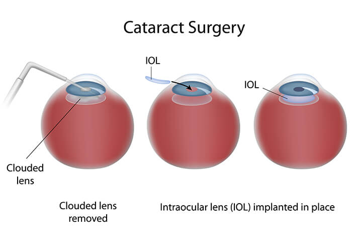 Cataract Surgery Portland Maine Chart Illustrating the Cataract Surgery Process