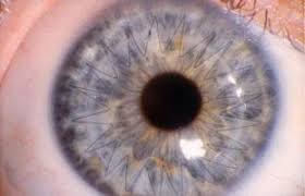 Cornea Transplant Maine Closeup of an Eye That Has Had a Cornea Transplant