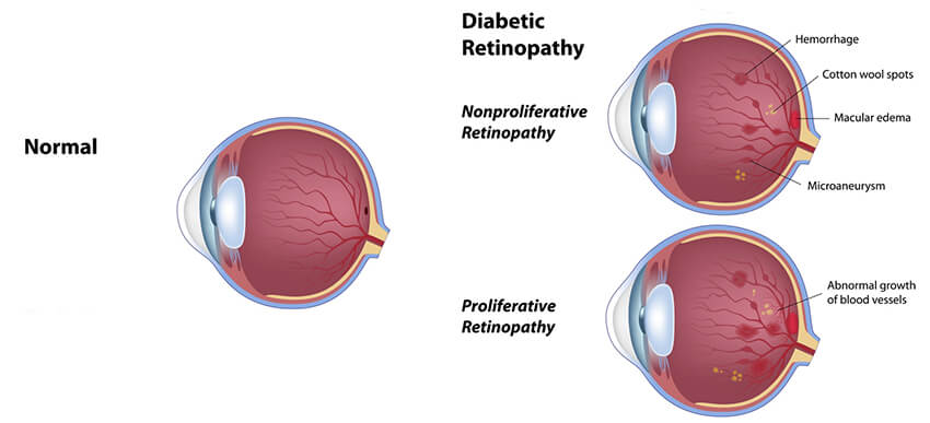Diabetic Retinopathy Maine Diabetic Retinopathy Diagram