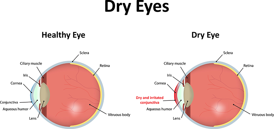 Dry Eyes Maine Dry Eyes Diagram