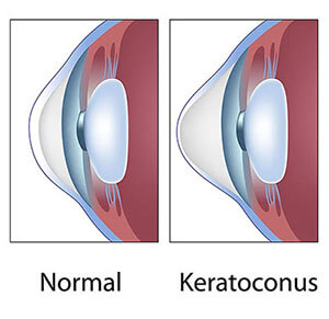 Keratoconus Maine Chart Showing a Healthy Eye Compared to One With Keratoconus