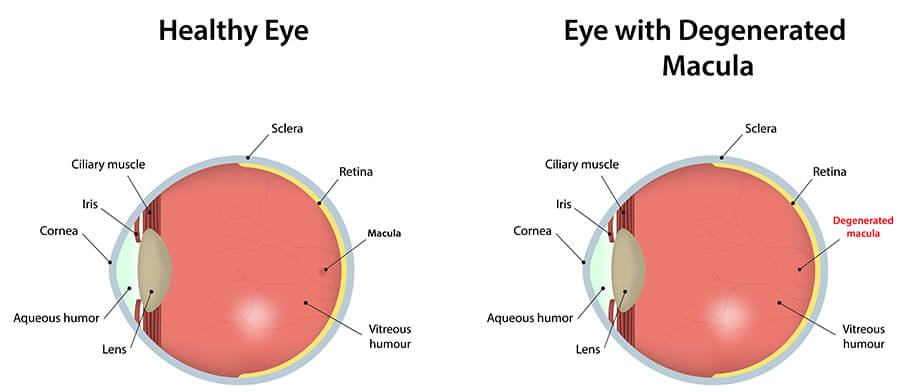 Macular Degeneration Maine Macular Degeneration Diagram