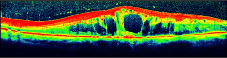 OCT Scan OCT Scan Example