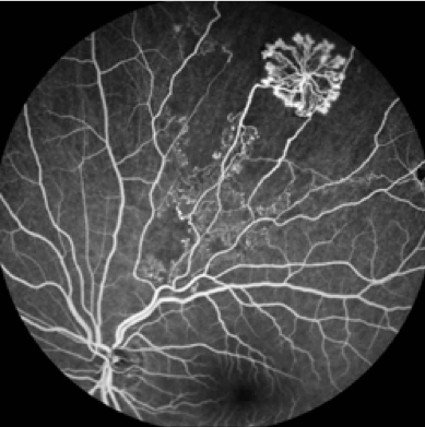 Fluorescein Angiography Fluorescein Angiography