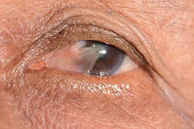 Pterygium Maine Pterygium Example