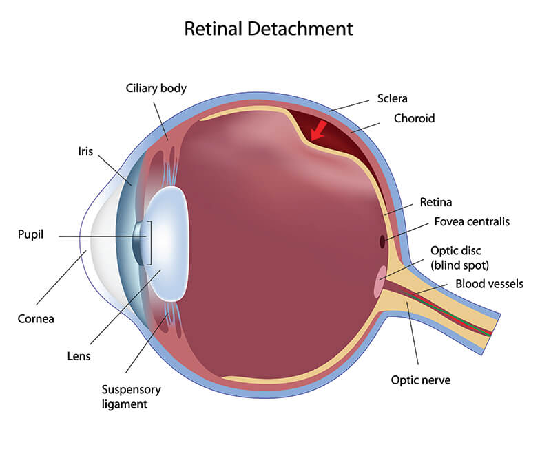 Retinal Detachment Maine Chart Illustrating a Retinal Detachment