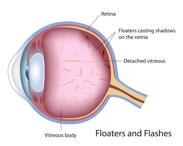 Eye Floaters Maine Flashes and Floaters Diagram